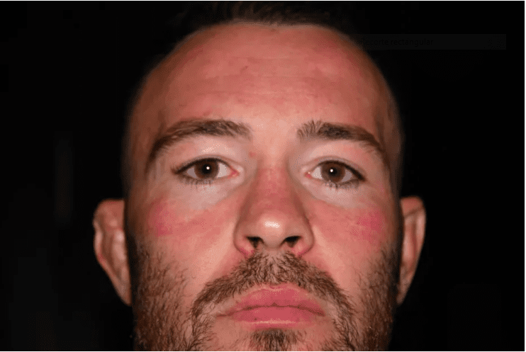 Colby Covington Lesión 3